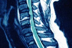 CENTRAL-CORD-SYNDROME-PIC