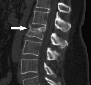 COMPRESSION-FRACTURE-PIC