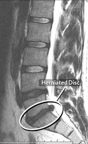HERNIATED-DISC-PIC