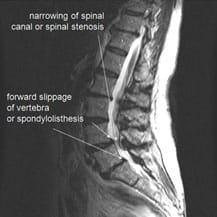 SPINAL-STENOSIS-PIC
