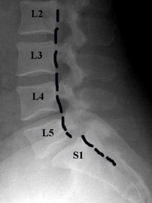 SPONDYLOLISTHESIS-PHOTO
